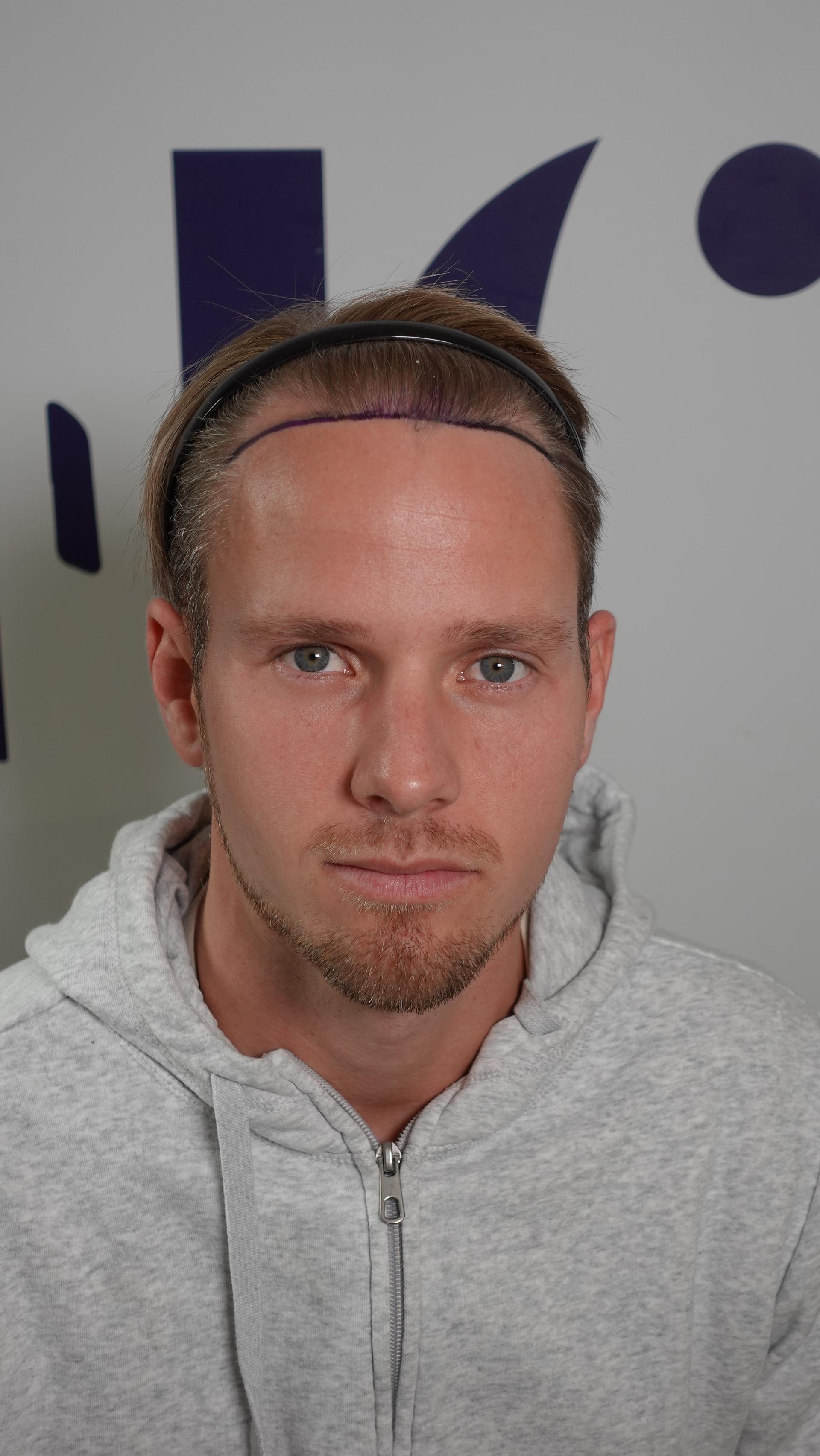 Haartransplantatie resultaat voor behandeling - 5