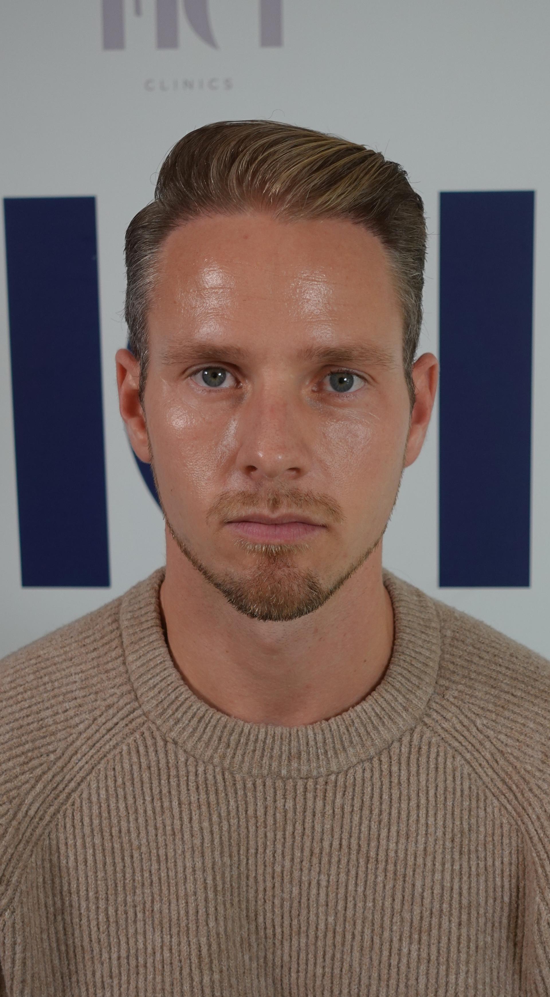 Haartransplantatie resultaat na behandeling - 5