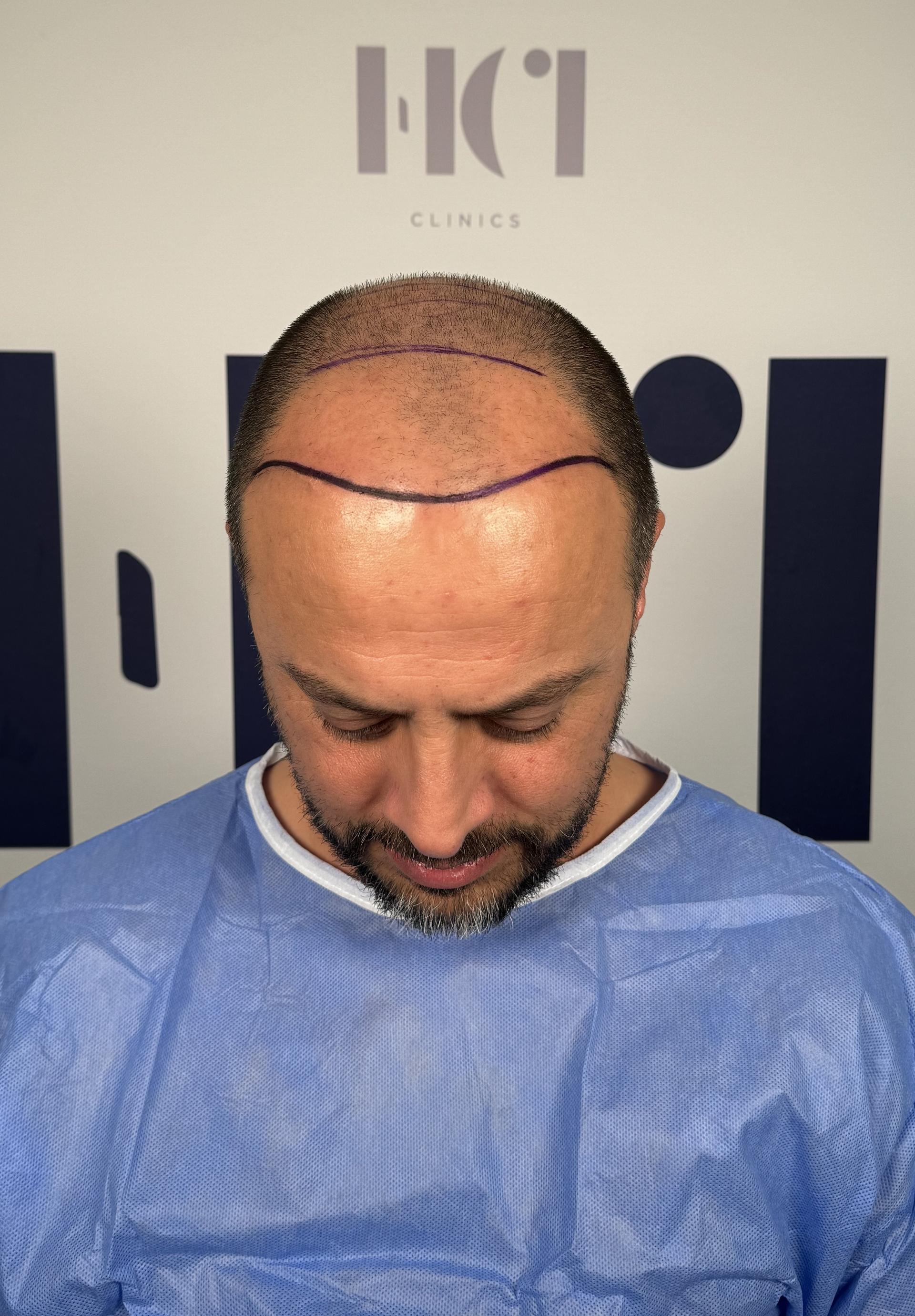 Haartransplantatie resultaat voor behandeling - 4