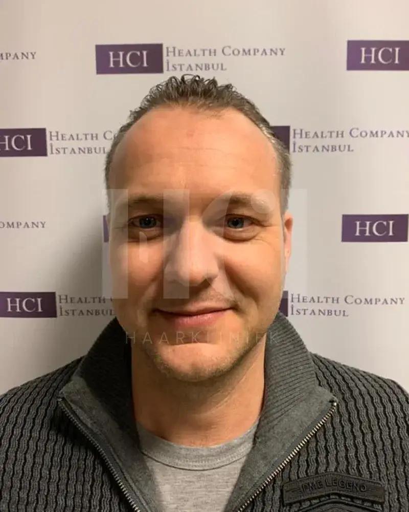Haartransplantatie resultaat voor behandeling - 5