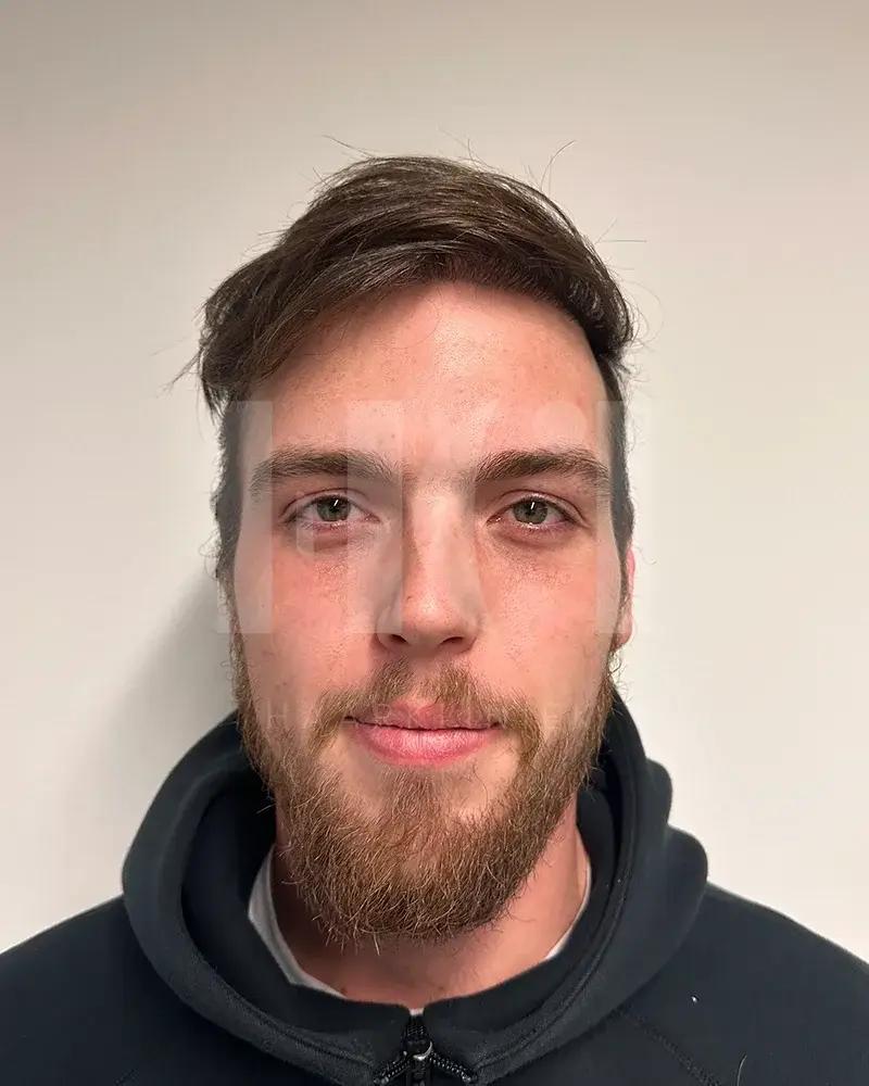 Haartransplantatie resultaat na behandeling - 2