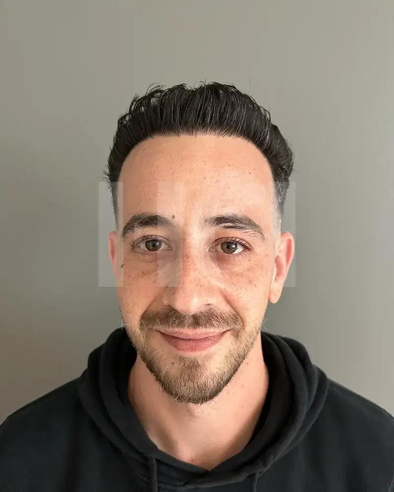 Haartransplantatie resultaat na behandeling - 3