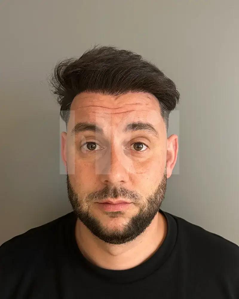 Haartransplantatie resultaat na behandeling - 4