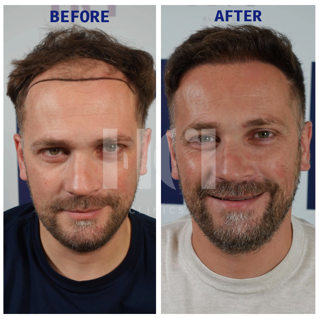 Before / After