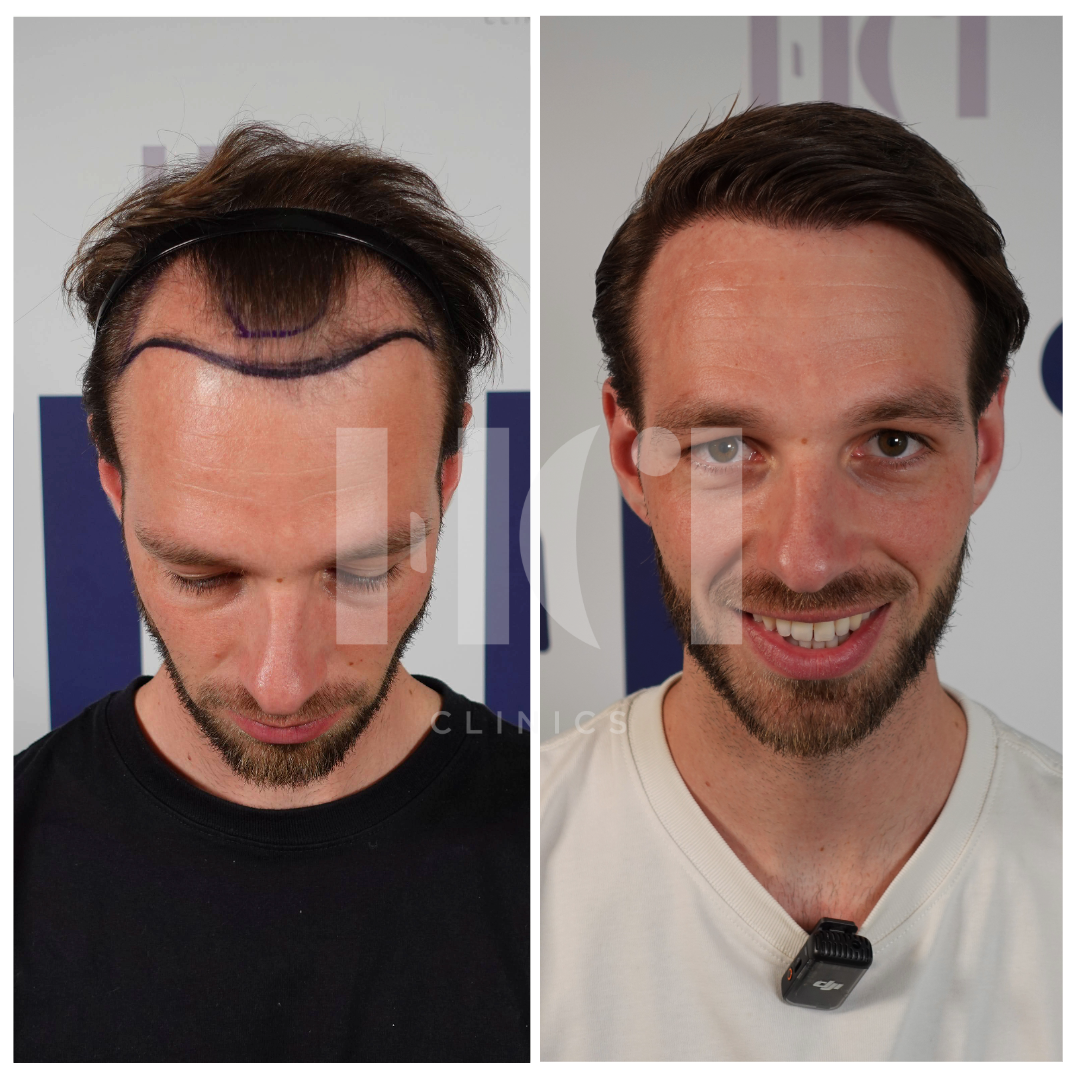 Before / After