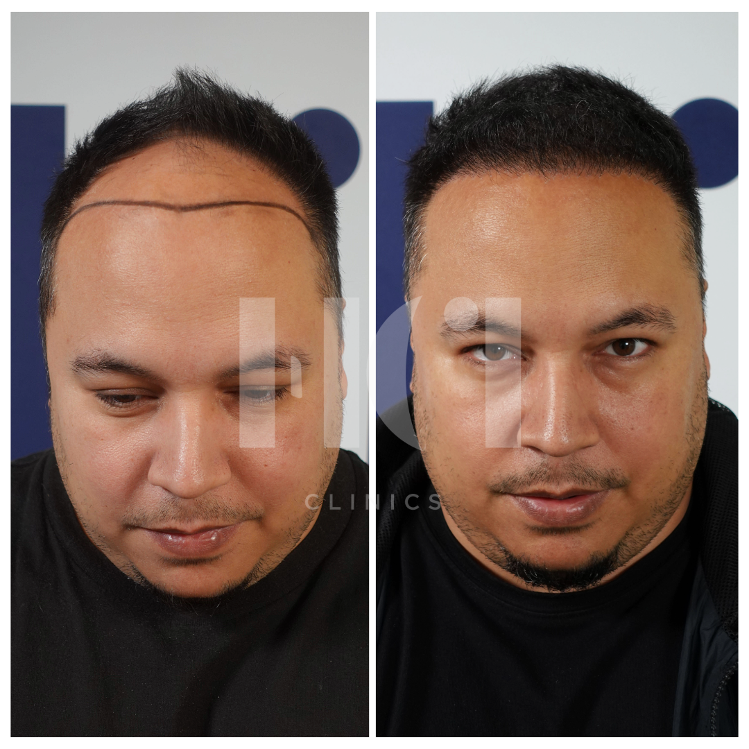 Before / After