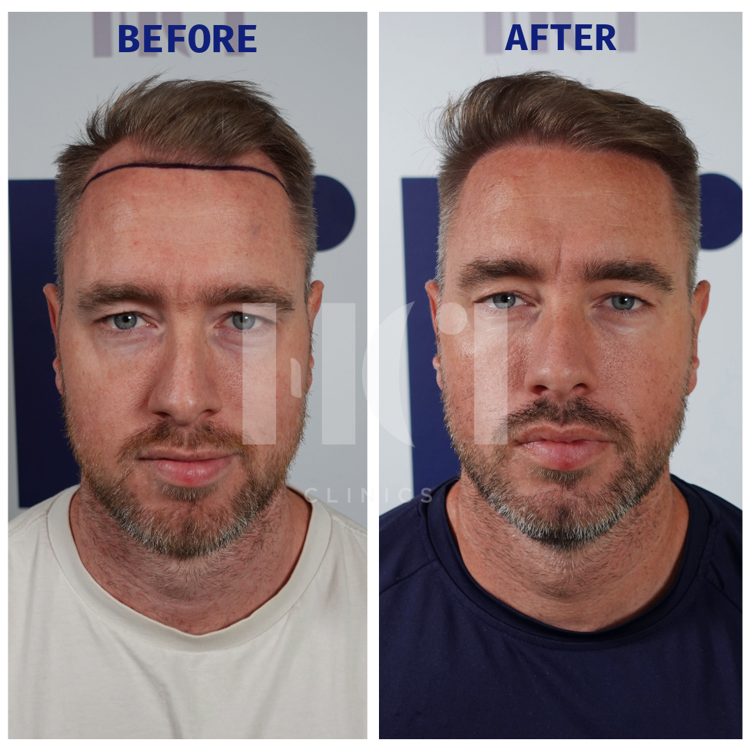 Before / After
