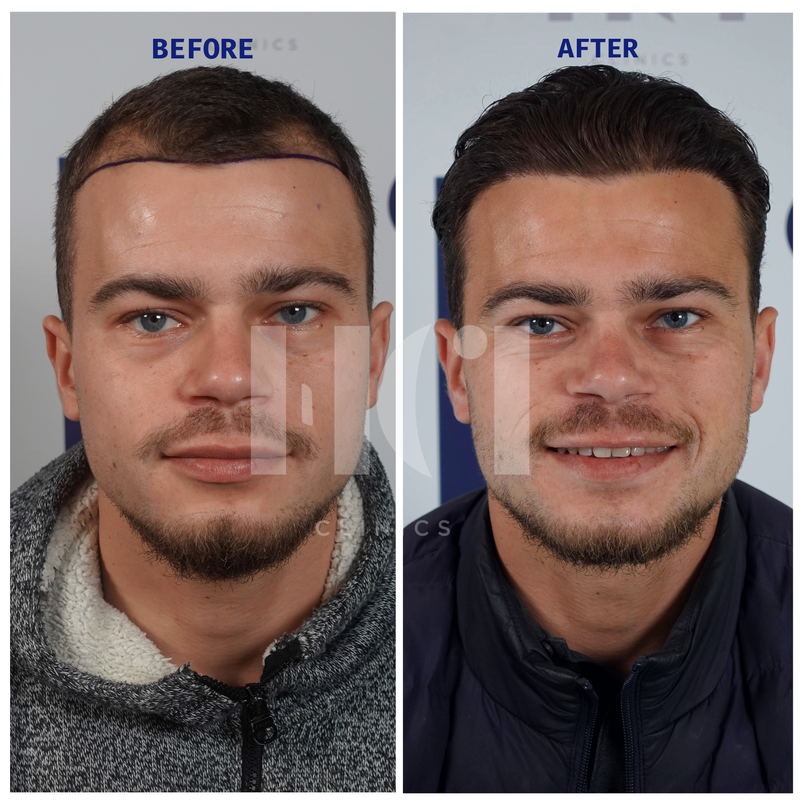 Before / After