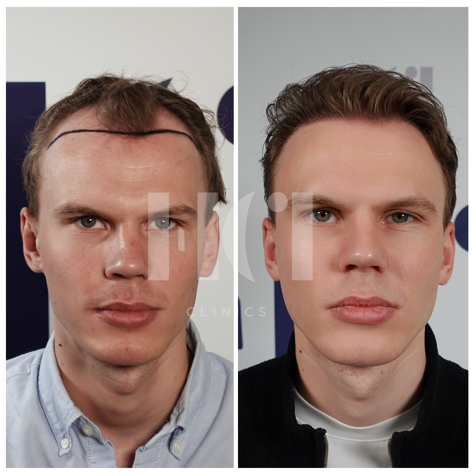 Before/After
