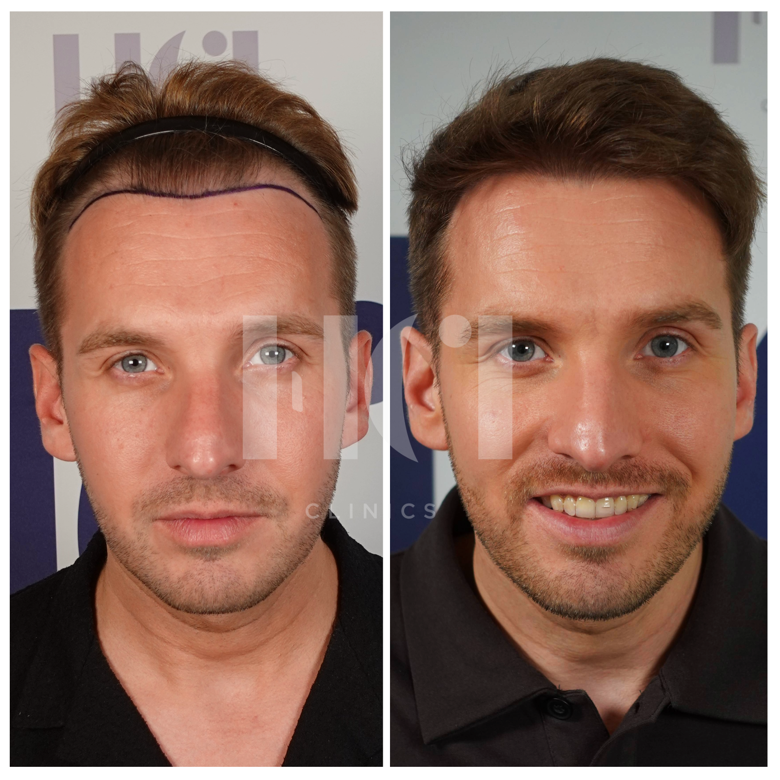 Before / After