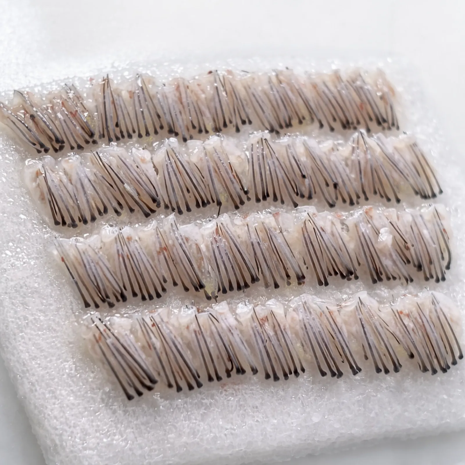 Haartransplantatie graft HCI Clinics