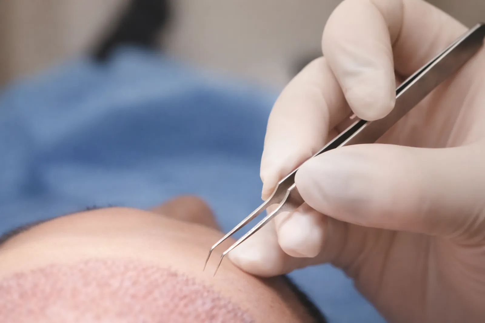 Haartransplantatie HCI Clinics